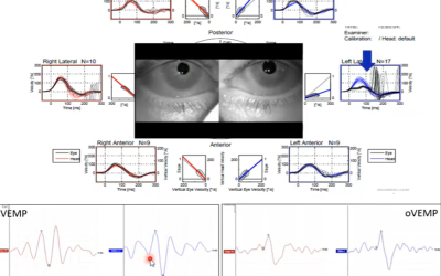 Dictan clase magistral sobre neuropatía vestibular aguda en la UACh Sede Puerto Montt